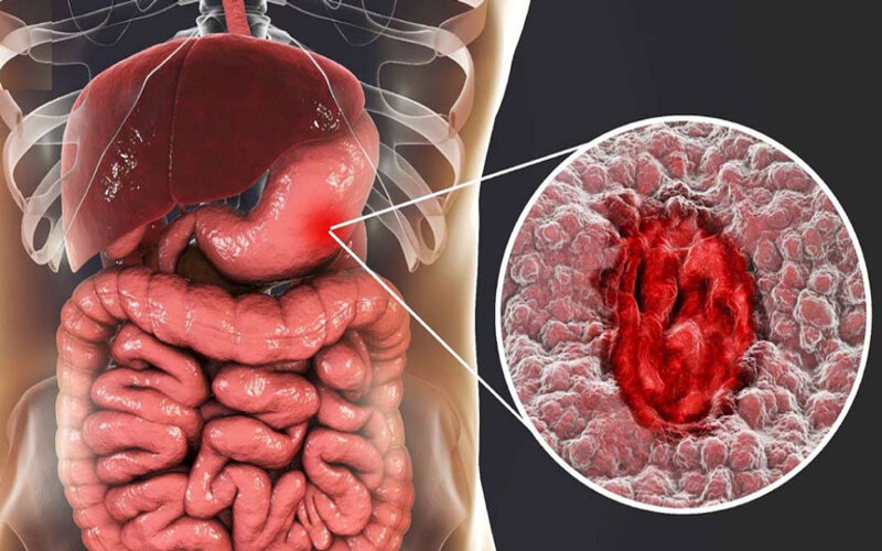 Triệu chứng ung thư dạ dày giai đoạn đầu: Những “cảnh báo” chớ xem thường